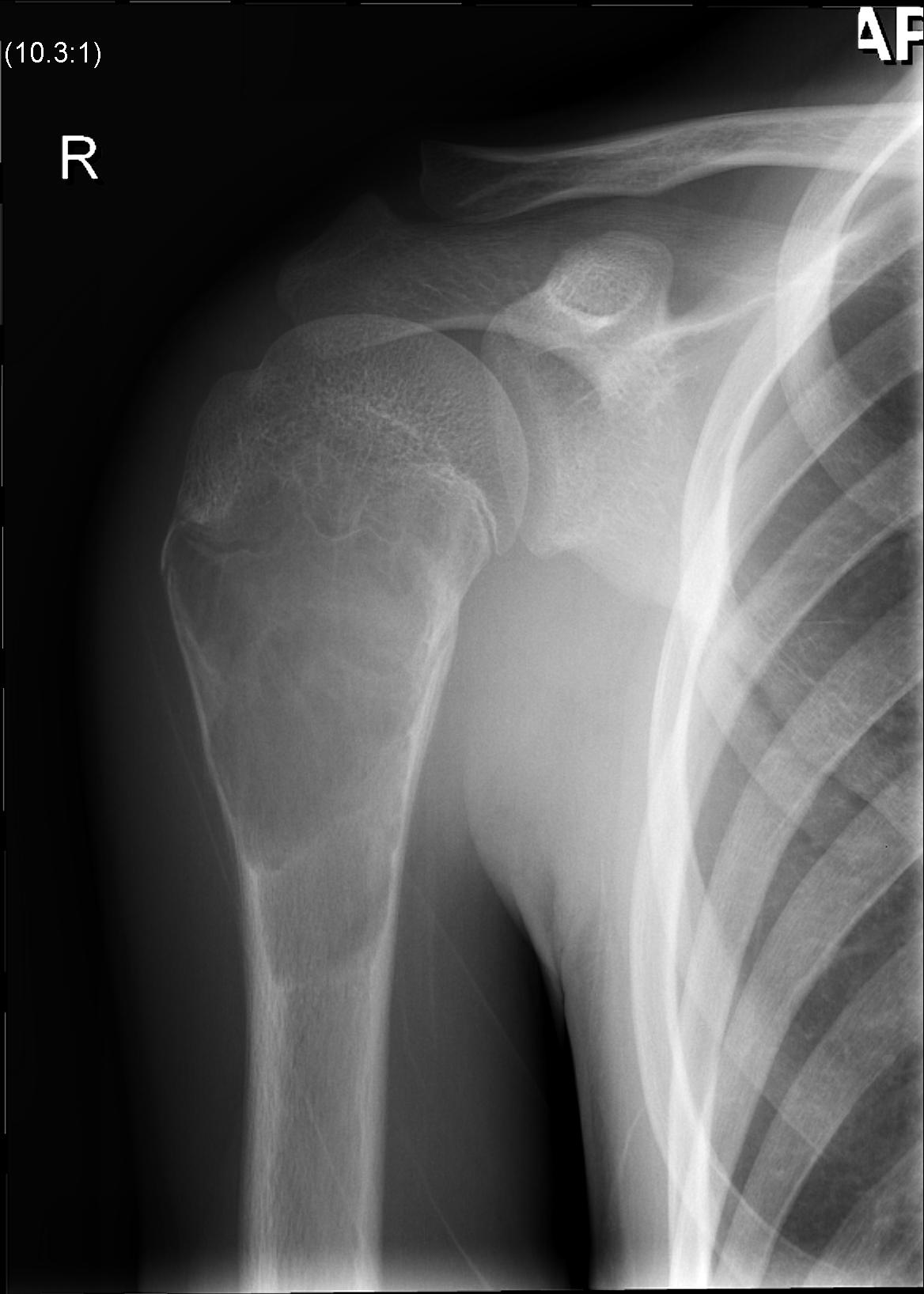 ABC Proximal Humerus